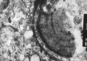 M,66y. | follicular cyst with hyaline Rushton bodies